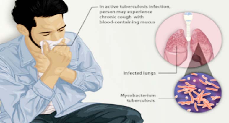 বিশ্ব যক্ষ্মা দিবস আজ